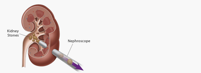 percutaneous lithotripsy